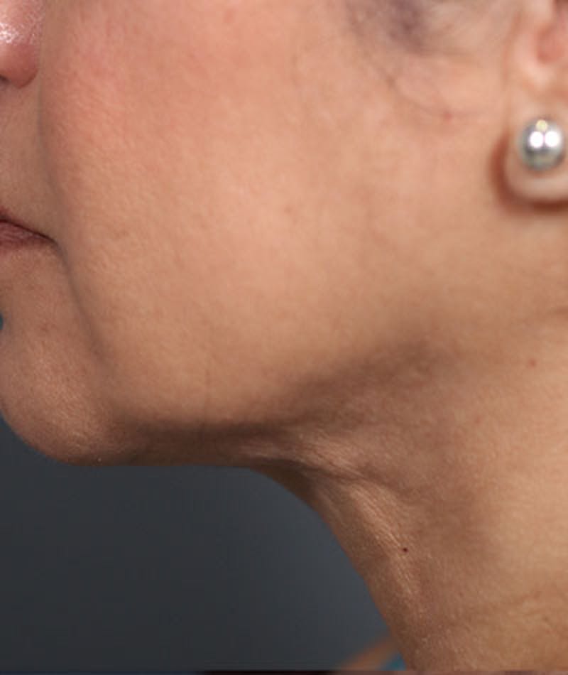 Neck Lift Before & After Gallery - Patient 108420700 - Image 14