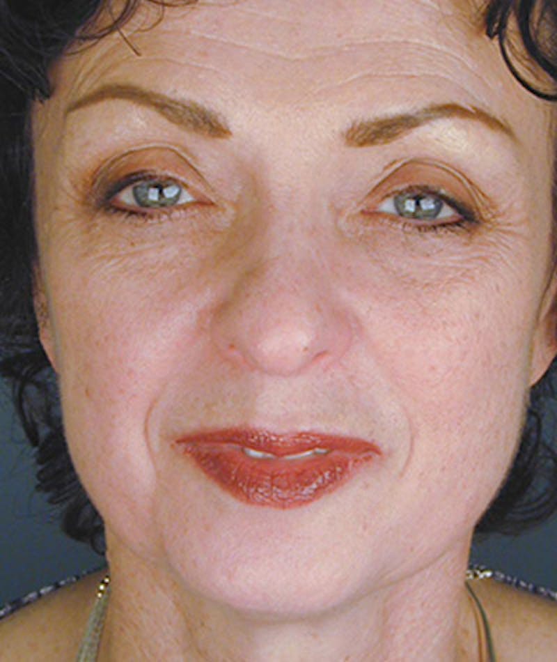 Brow Lift Before & After Gallery - Patient 108424847 - Image 1