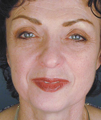 Brow Lift Before & After Gallery - Patient 108424847 - Image 1