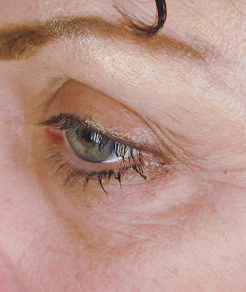 Brow Lift Before & After Gallery - Patient 108424847 - Image 3