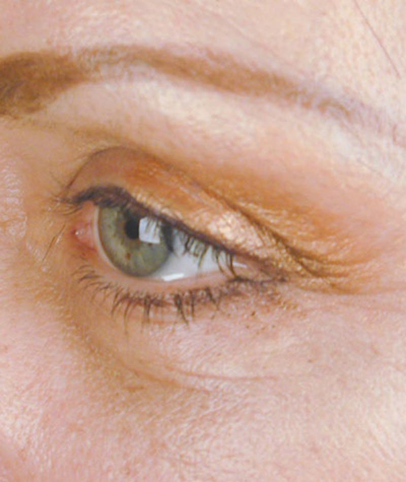 Brow Lift Before & After Gallery - Patient 108424847 - Image 4