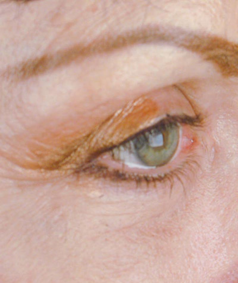 Brow Lift Before & After Gallery - Patient 108424847 - Image 6