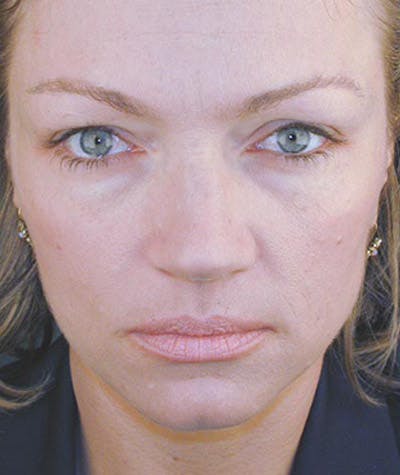 Brow Lift Before & After Gallery - Patient 108434273 - Image 1