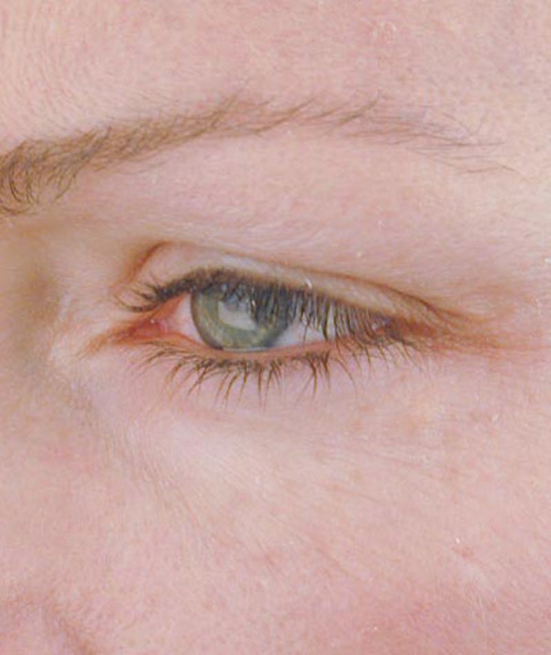 Brow Lift Before & After Gallery - Patient 108434273 - Image 3
