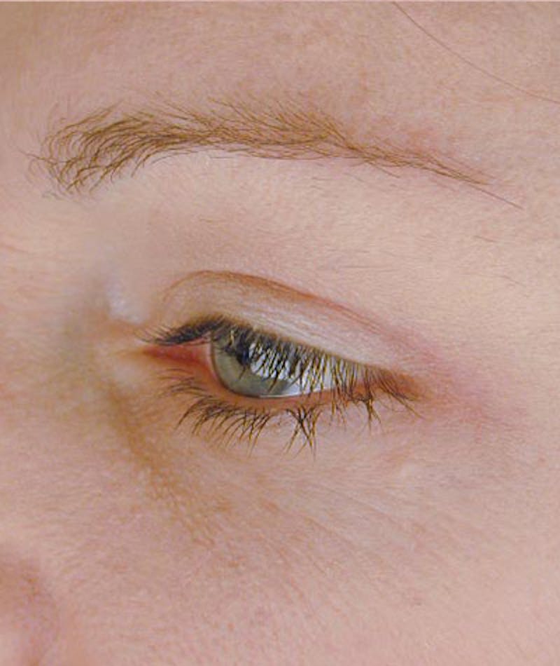 Brow Lift Before & After Gallery - Patient 108434273 - Image 4