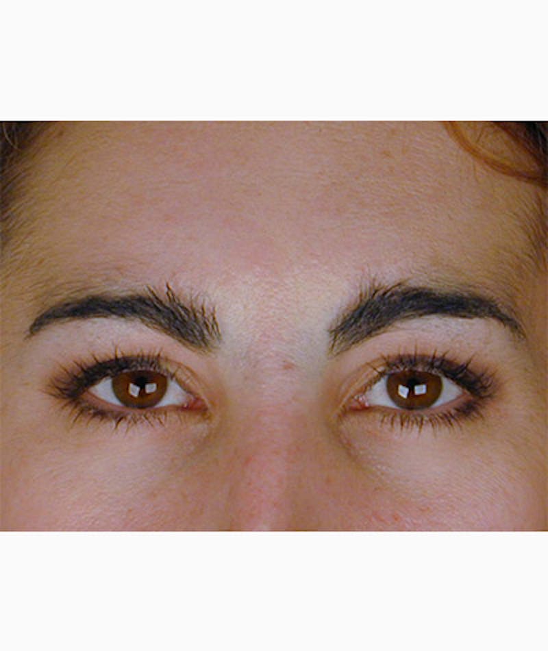 Brow Lift Before & After Gallery - Patient 108434280 - Image 1