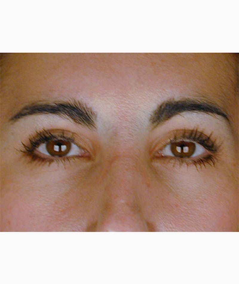 Brow Lift Before & After Gallery - Patient 108434280 - Image 2