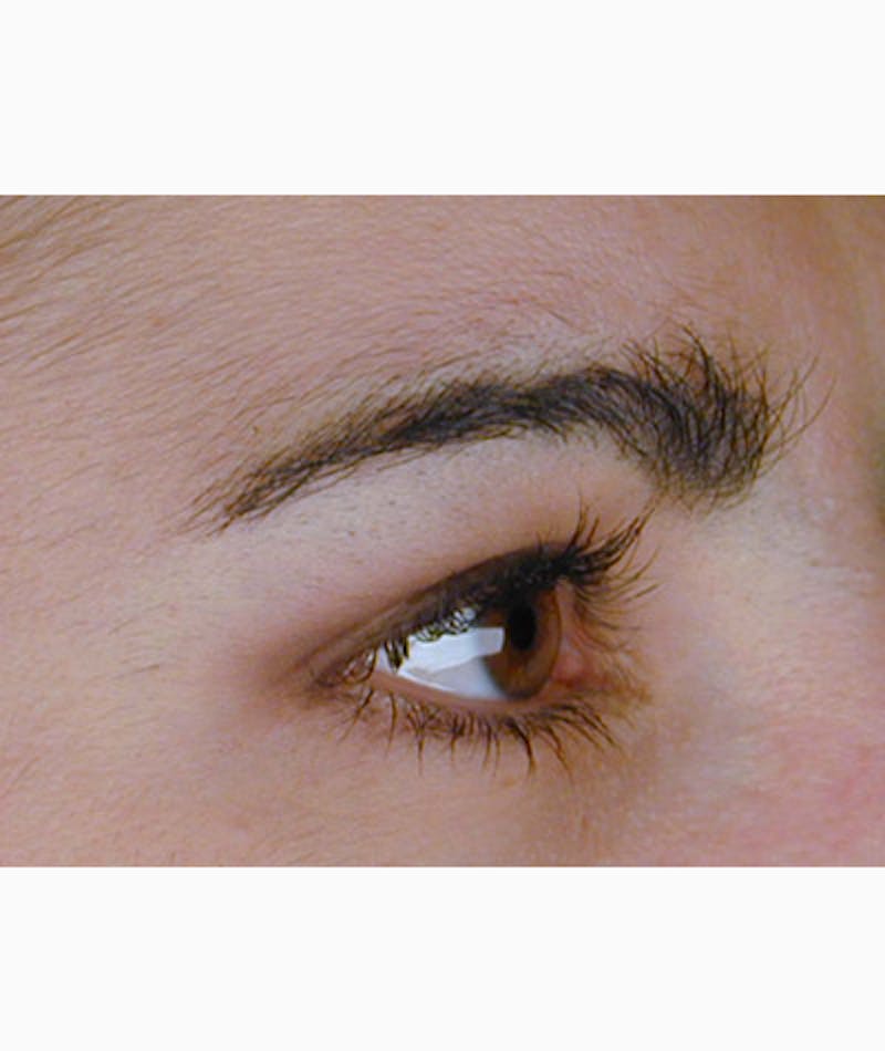 Brow Lift Before & After Gallery - Patient 108434280 - Image 3
