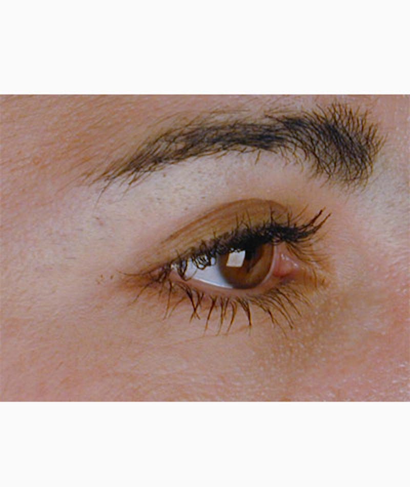 Brow Lift Before & After Gallery - Patient 108434280 - Image 4