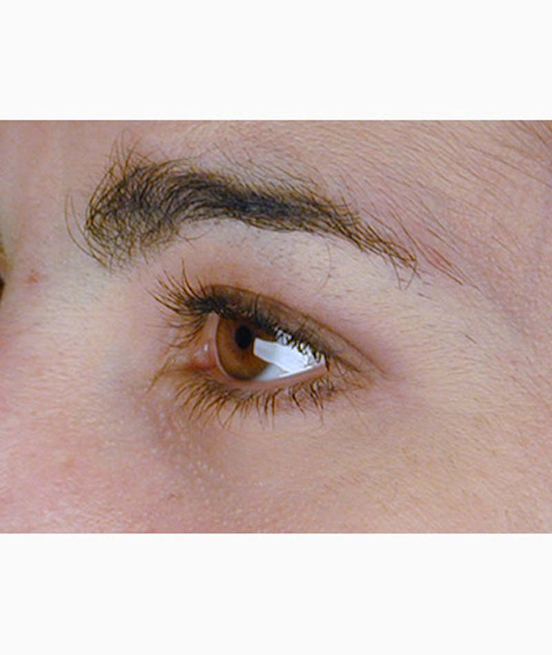 Brow Lift Before & After Gallery - Patient 108434280 - Image 5