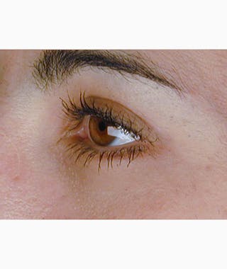 Brow Lift Before & After Gallery - Patient 108434280 - Image 6