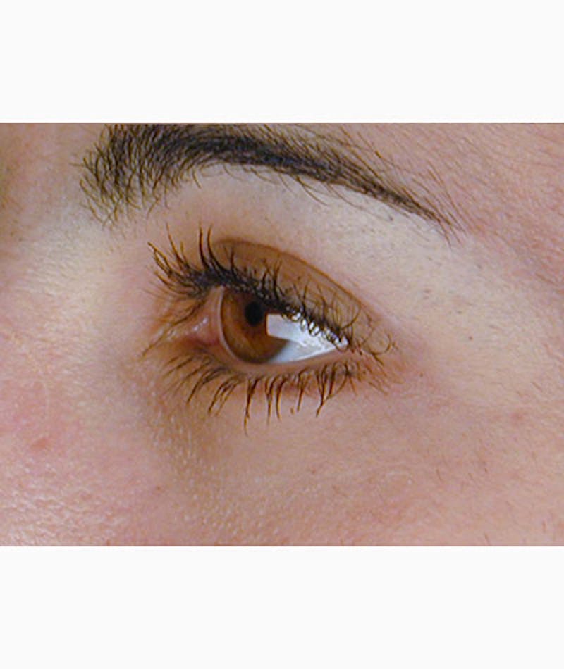 Brow Lift Before & After Gallery - Patient 108434280 - Image 6