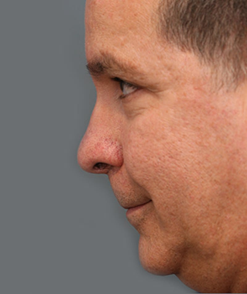 Chin Augmentation Before & After Gallery - Patient 108434310 - Image 2