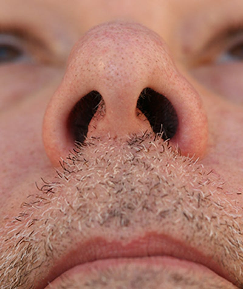 Chin Augmentation Before & After Gallery - Patient 108434310 - Image 7