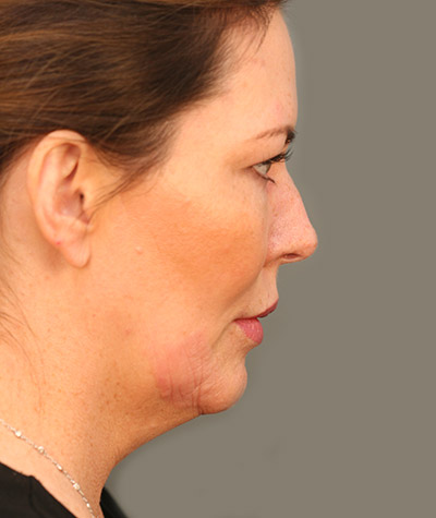 Patient 108434315 | Chin Augmentation Before & After Photos