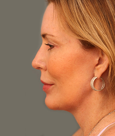 Patient 108434315 | Chin Augmentation Before & After Photos