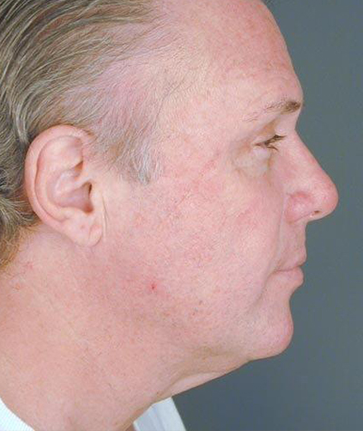 Patient 108434320 | Chin Augmentation Before & After Photos