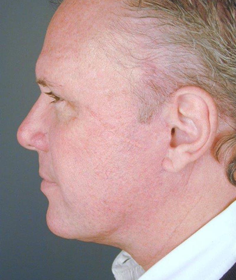 Chin Augmentation Before & After Gallery - Patient 108434320 - Image 2