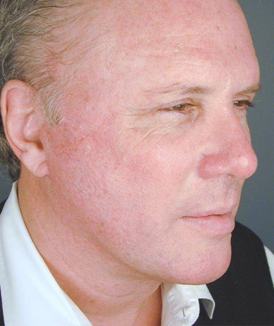 Patient 108434320 | Chin Augmentation Before & After Photos