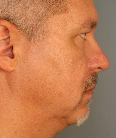 Patient 108434333 | Chin Augmentation Before & After Photos