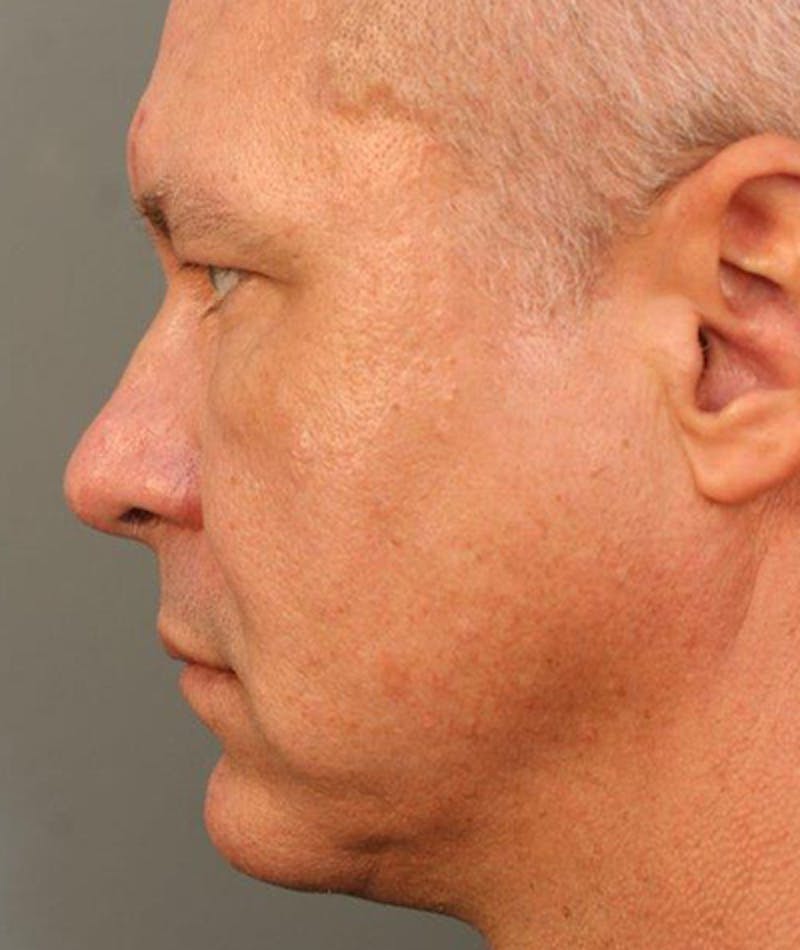 Chin Augmentation Gallery - Patient 108434333 - Image 2