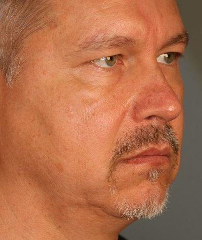 Patient 108434333 | Chin Augmentation Before & After Photos