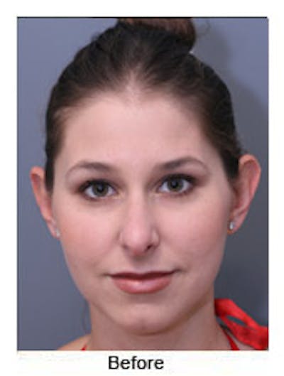 Otoplasty Before & After Gallery - Patient 108434374 - Image 1