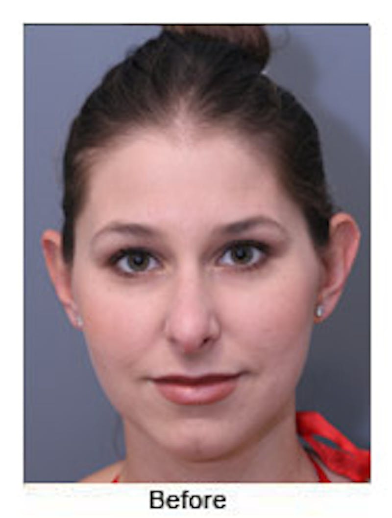 Otoplasty Before & After Gallery - Patient 108434374 - Image 1