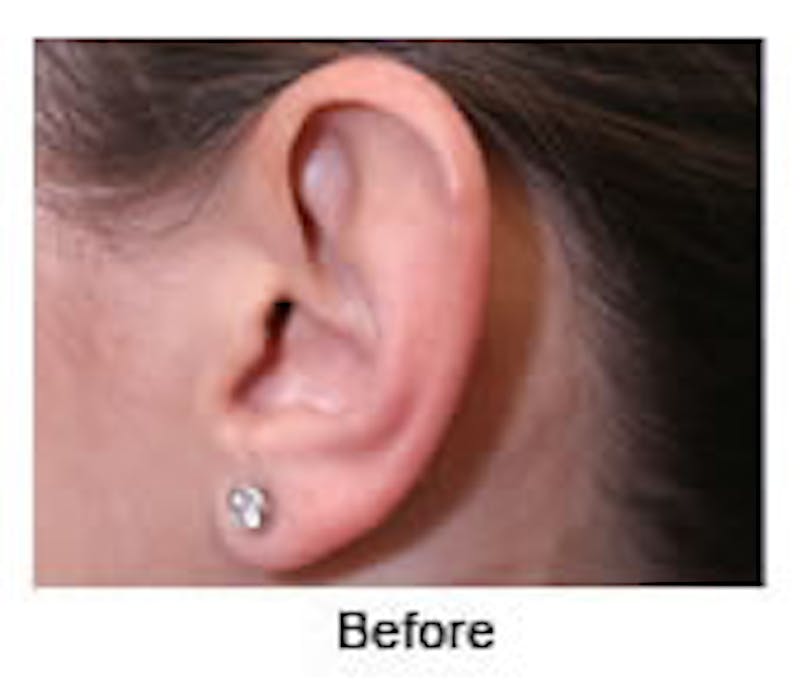 Otoplasty Before & After Gallery - Patient 108434374 - Image 9