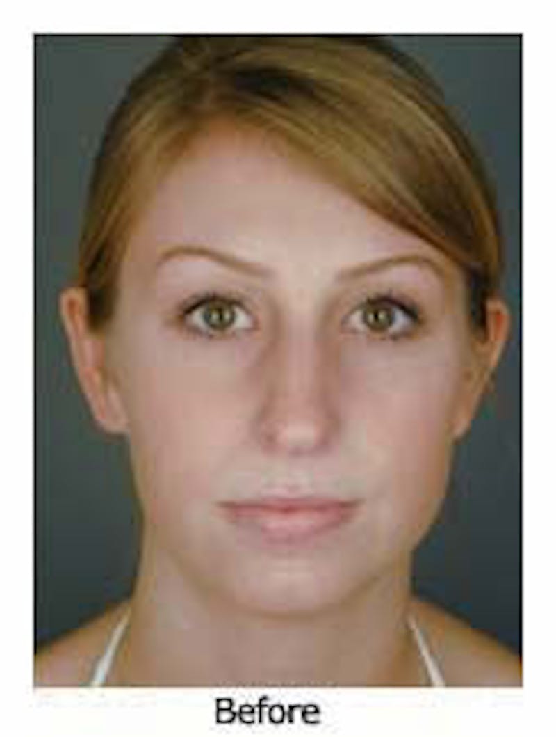 Otoplasty Before & After Gallery - Patient 108434391 - Image 1