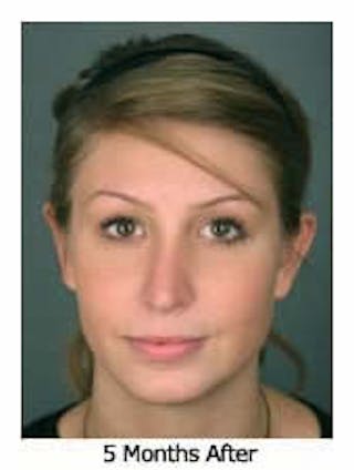 Otoplasty Before & After Gallery - Patient 108434391 - Image 2