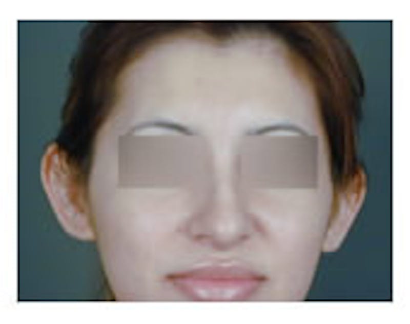 Otoplasty Before & After Gallery - Patient 108434396 - Image 1