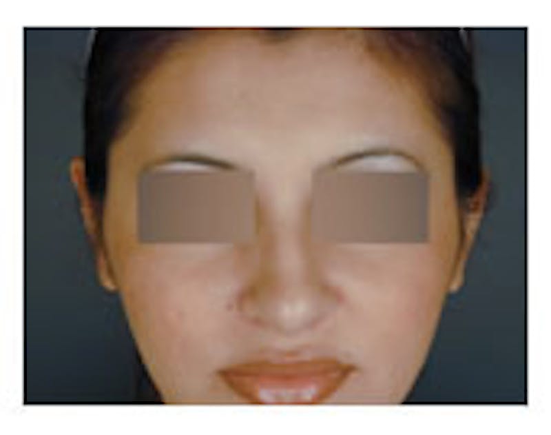 Otoplasty Before & After Gallery - Patient 108434396 - Image 2