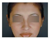 Otoplasty Before & After Gallery - Patient 108434396 - Image 2