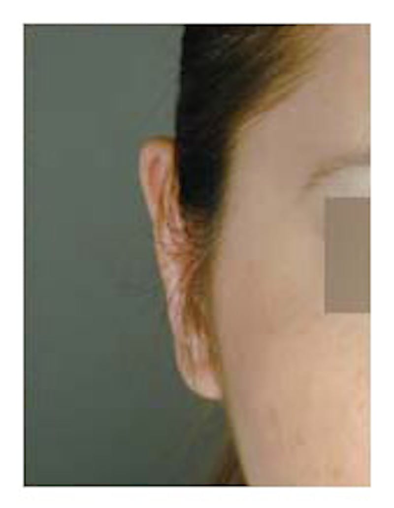 Otoplasty Before & After Gallery - Patient 108434396 - Image 4