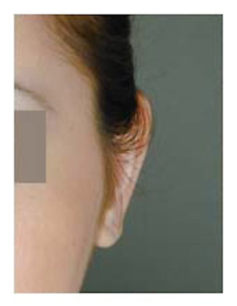 Otoplasty Before & After Gallery - Patient 108434396 - Image 6