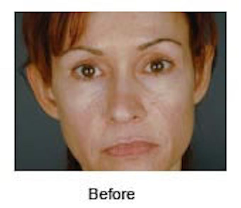 Otoplasty Before & After Gallery - Patient 108435012 - Image 1