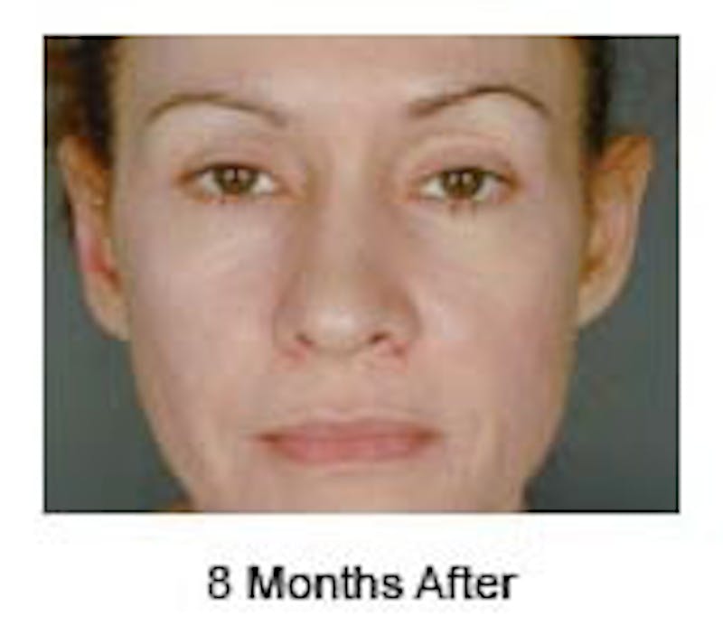 Otoplasty Before & After Gallery - Patient 108435012 - Image 2