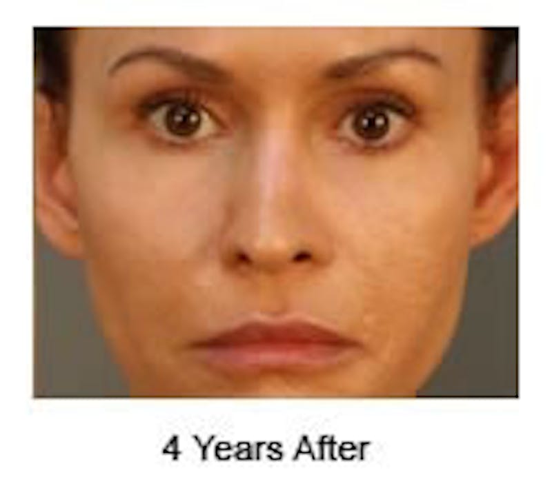 Otoplasty Before & After Gallery - Patient 108435012 - Image 4