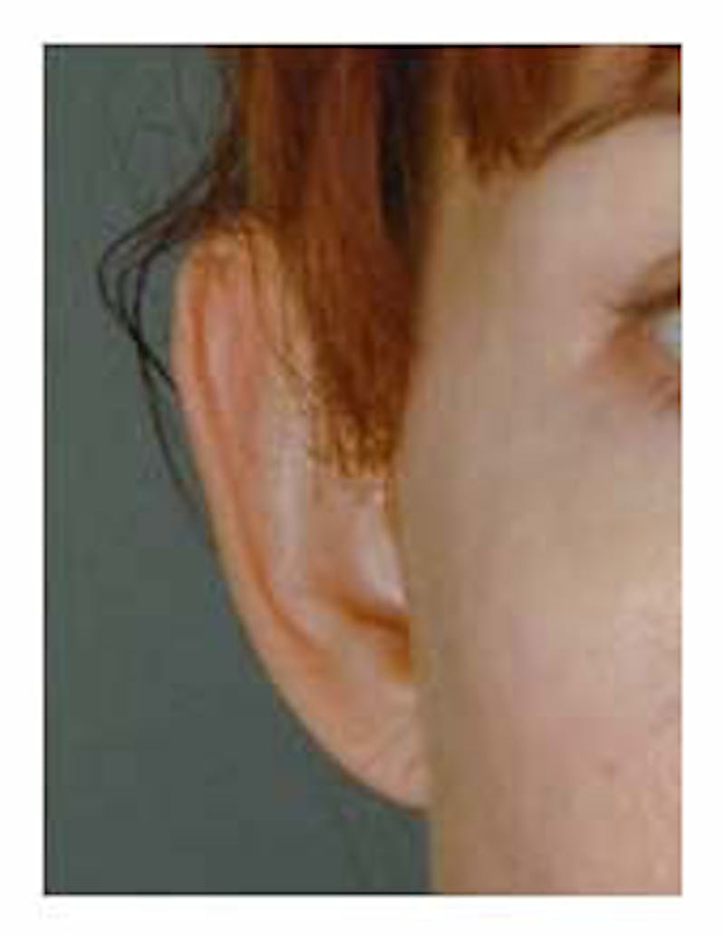 Otoplasty Before & After Gallery - Patient 108435012 - Image 5