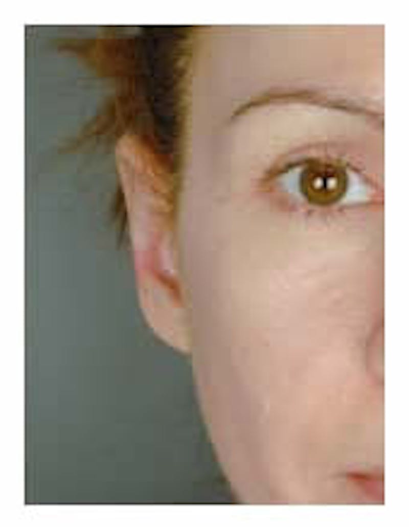 Otoplasty Before & After Gallery - Patient 108435012 - Image 6