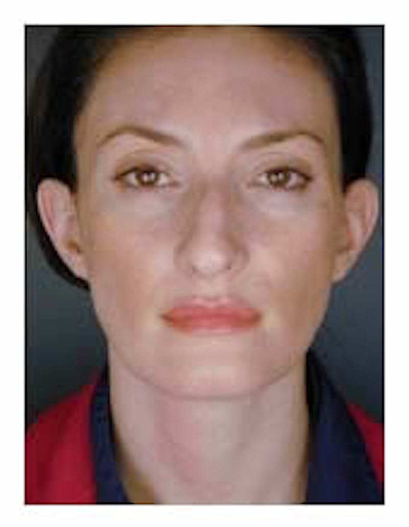 Otoplasty Before & After Gallery - Patient 108435022 - Image 1