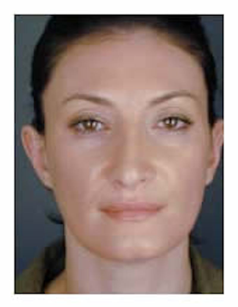Otoplasty Before & After Gallery - Patient 108435022 - Image 2