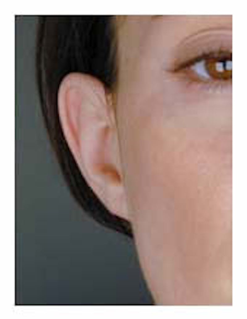 Otoplasty Before & After Gallery - Patient 108435022 - Image 3