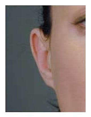 Otoplasty Before & After Gallery - Patient 108435022 - Image 4