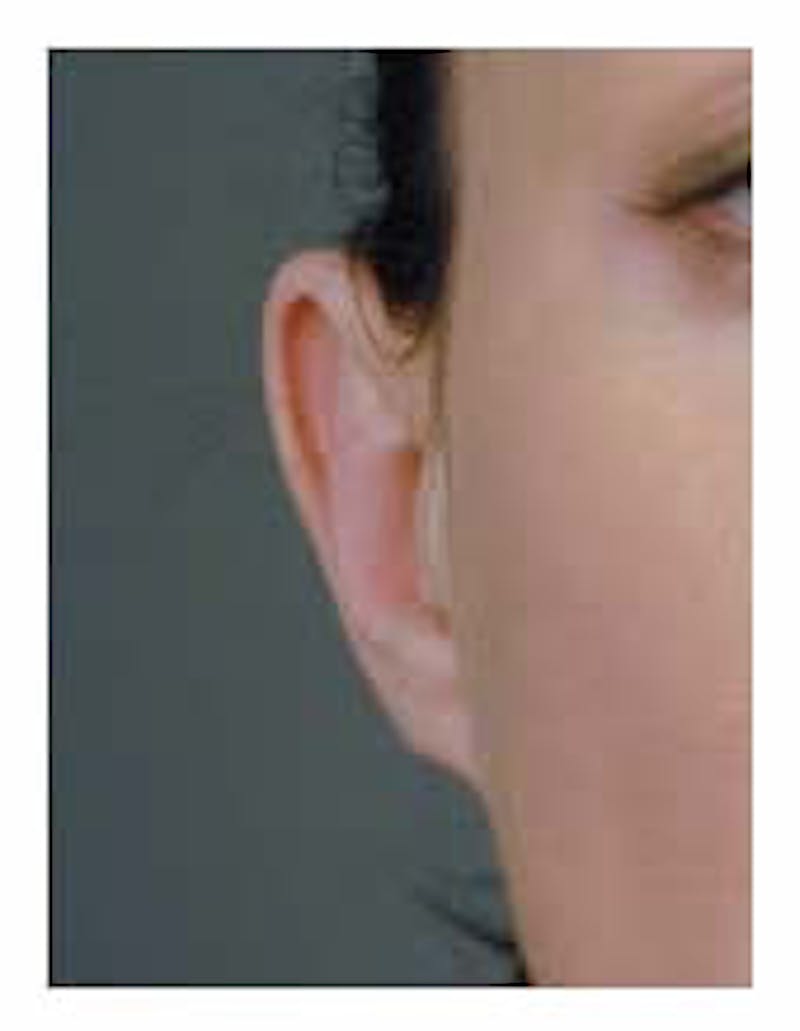 Otoplasty Before & After Gallery - Patient 108435022 - Image 4