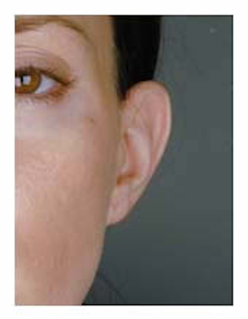 Otoplasty Before & After Gallery - Patient 108435022 - Image 5