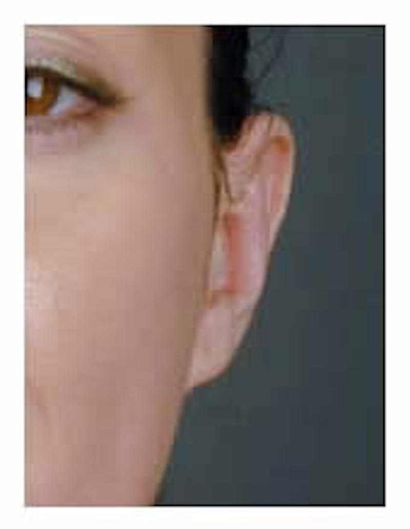 Otoplasty Before & After Gallery - Patient 108435022 - Image 6