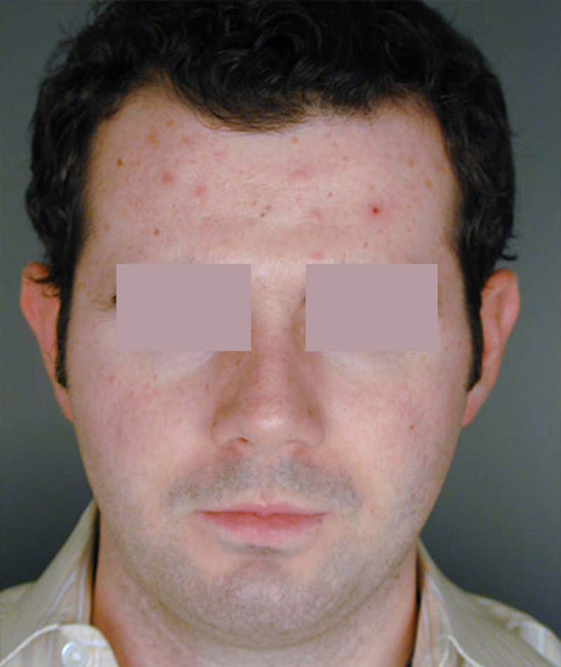Otoplasty Before & After Gallery - Patient 108435054 - Image 1