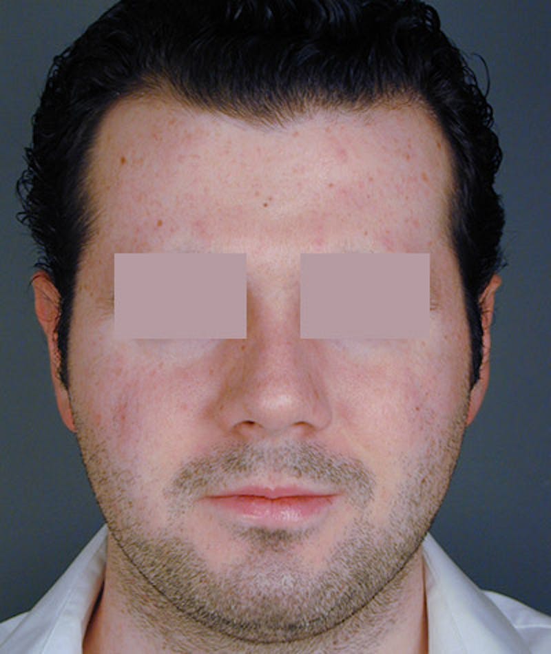 Otoplasty Before & After Gallery - Patient 108435054 - Image 2